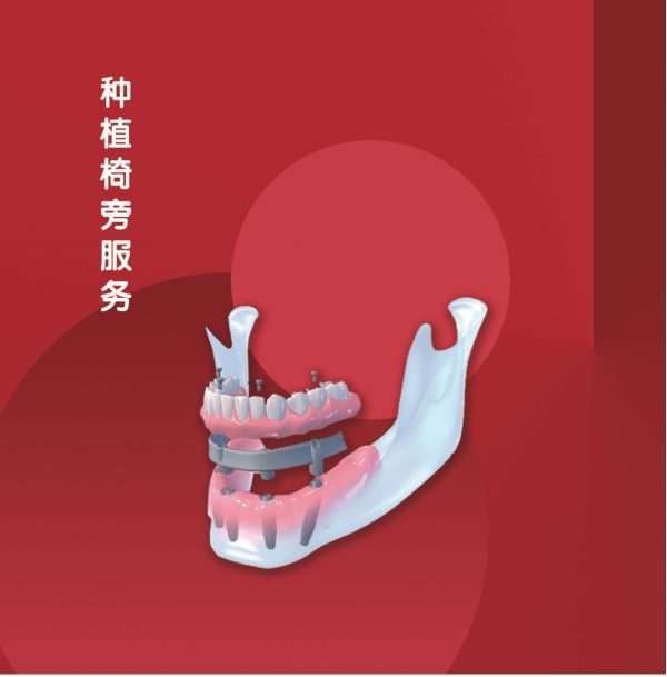 种植椅旁服务